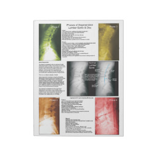 Bloc-note Arrachez la dégénérescence spinale lombaire de