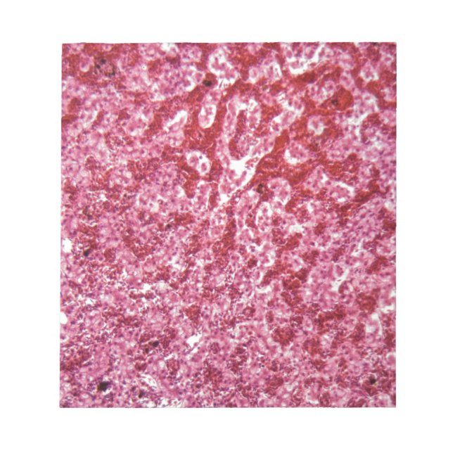 Bloc-note Cellules hépatiques humaines avec cancer (Devant)
