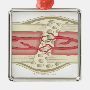 Bone Repairing Itself 2 Metal Ornament