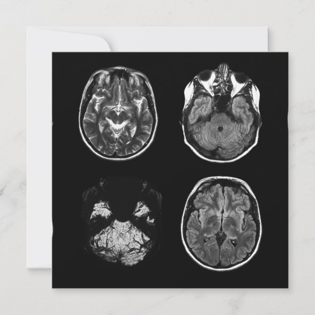 Brain MRI scan (Front)
