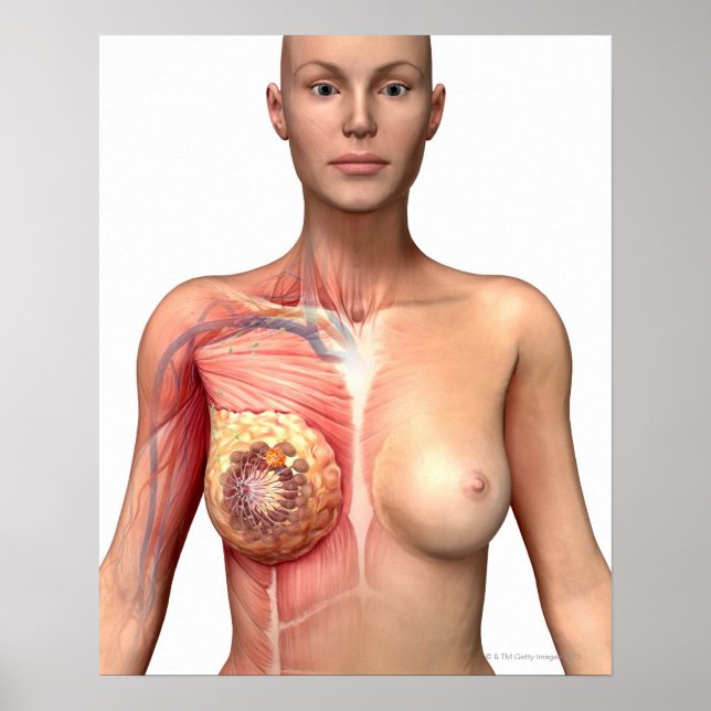 Breast cancer poster (Front)