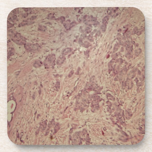 Breast cancer under the microscope coaster (Front)