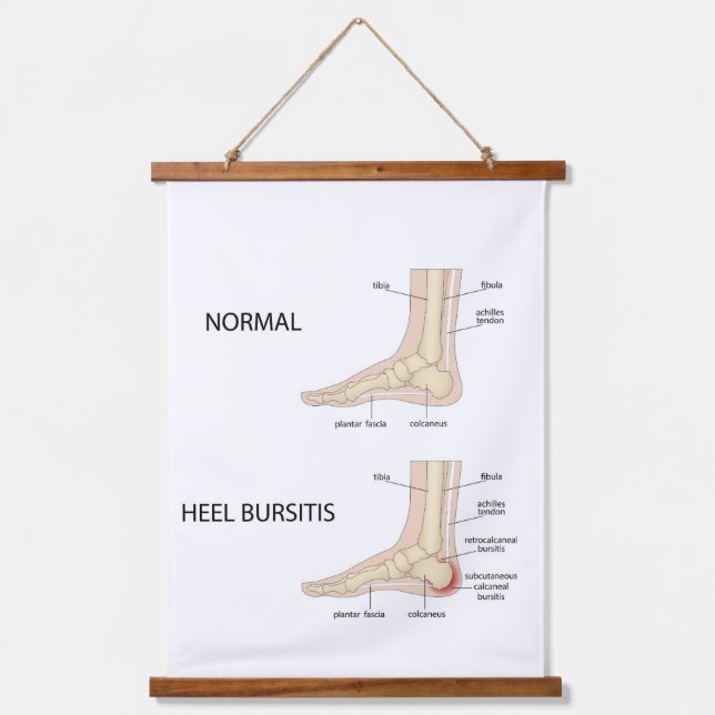 Calcaneal bursitis hanging tapestry (Front)