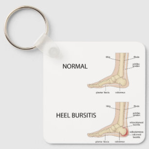Calcaneal bursitis keychain