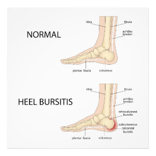 Calcaneal bursitis Photo Print