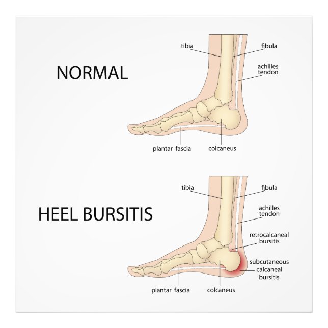  Calcaneal bursitis Photo Print (Front)