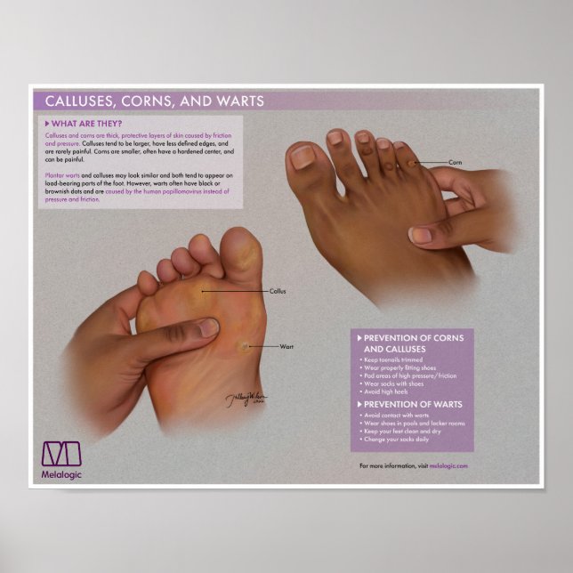 Callus, cornes et tourbières mélalogiques Poster M (Devant)
