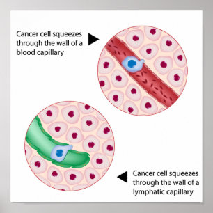 Cancer cell metastasis Poster