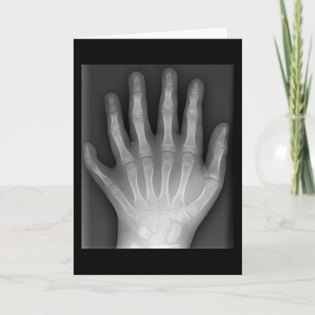 Carte Polydactylo, Six Doigts, X-Ray, rareté ! (Devant)