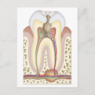 Carte Postale Abcès de pâte et racine