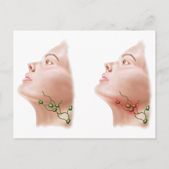 Carte Postale Anatomie Des Noeuds Lymphe Gonflés (Devant)