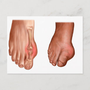 Carte Postale Anatomie D'Un Pied Gonflé