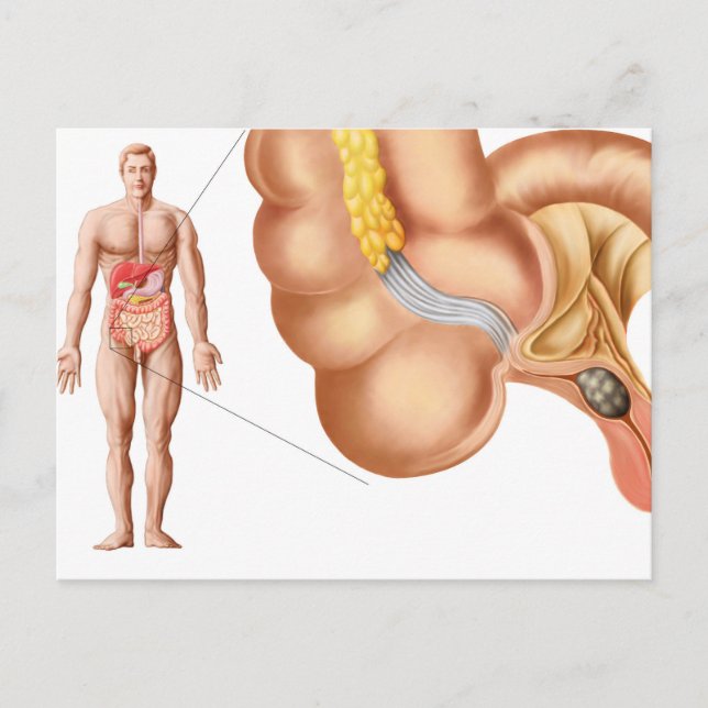Carte Postale Illustration Médicale D'Un Appendice (Devant)