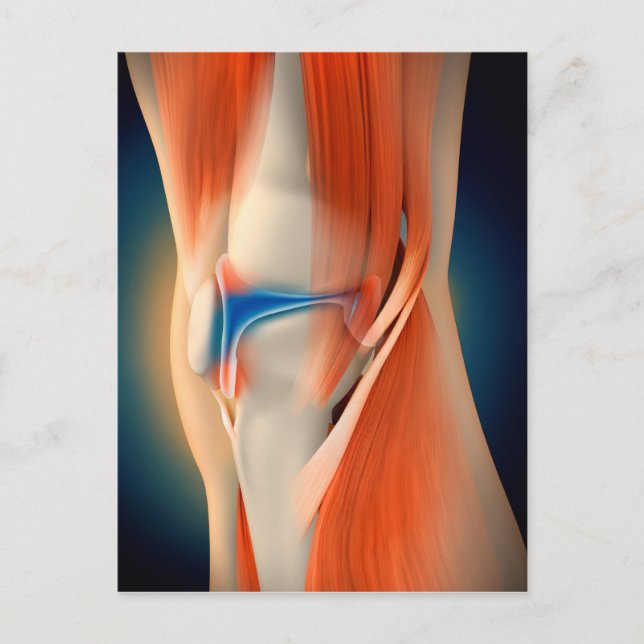 Carte Postale Illustration Médicale : Inflammation Dans Le Genou (Devant)