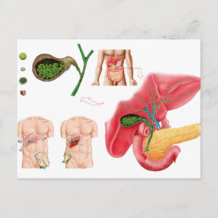 Carte Postale Illustration montrant la cholécystectomie