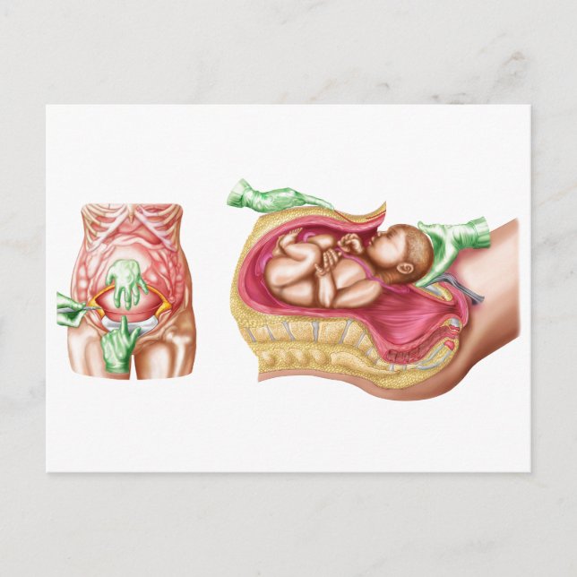 Carte Postale Illustration Montrant La Livraison Cesarienne Du F (Devant)