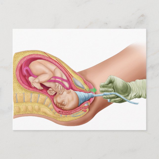 Carte Postale Illustration Montrant La Livraison Du Foetus 1 (Devant)