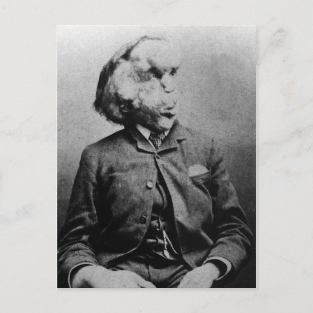Carte Postale Joseph "John" Merrick L'homme éléphant de 1889 (Devant)