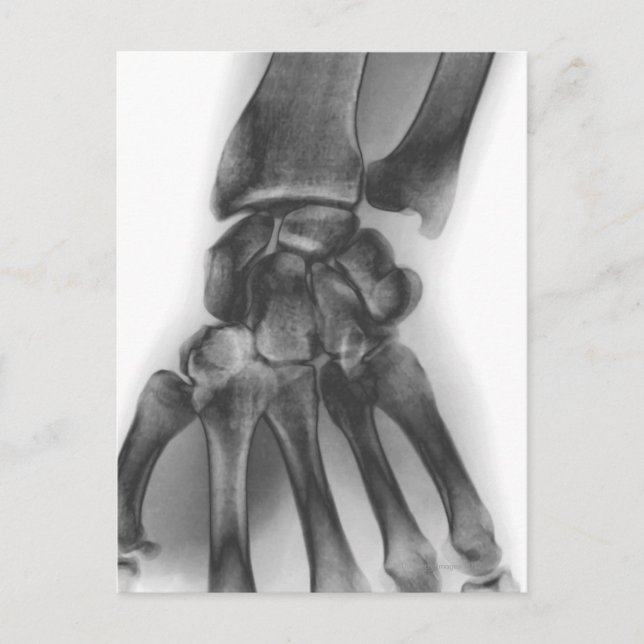 Carte Postale Poignet normal, rayon X (Devant)
