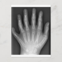 Polydactylo, Six Doigts, X-Ray, rareté !