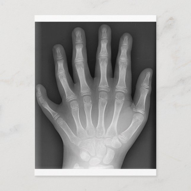 Carte Postale Polydactylo, Six Doigts, X-Ray, rareté ! (Devant)