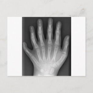 Carte Postale Polydactylo, Six Doigts, X-Ray, rareté !