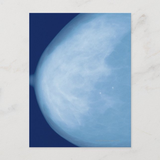 Carte Postale Rayon X du sein féminin, vue latérale (Devant)