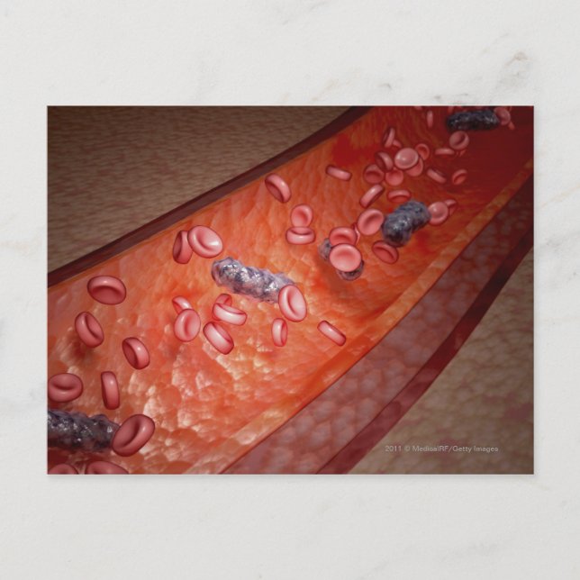 Carte Postale Rendu microscopique d'une infection sanguine (Devant)