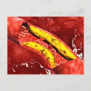 Carte Postale Vue Microscopique De Plaque Grasse À L'Intérieur D