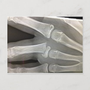 Carte Postale x-ray os cassés se remettre bientôt