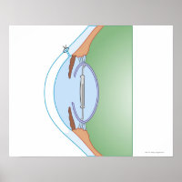 Cataract Surgery