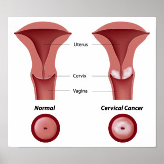 Cervical cancer Poster