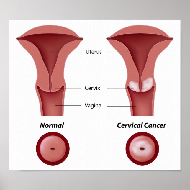 Cervical cancer  Poster (Front)