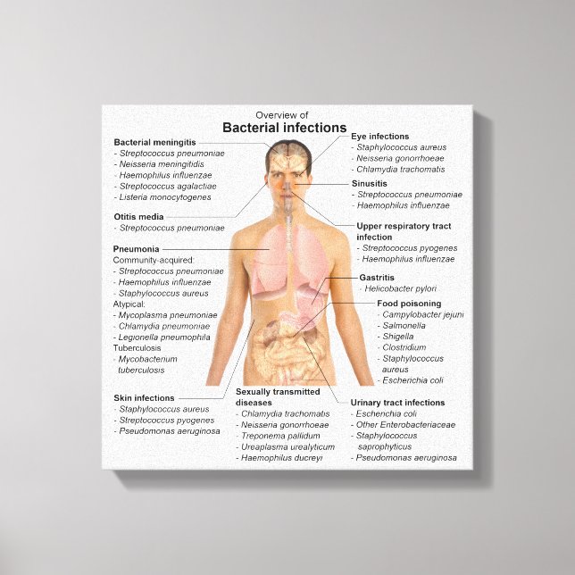 Chart of the bacterial infections in Humans  Canvas Print (Front)