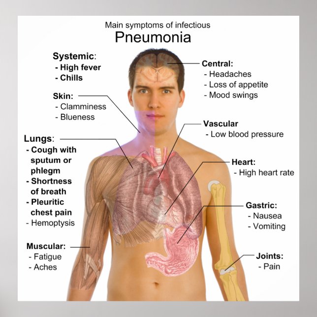 Chart of the Symptoms of Pneumonia (Front)