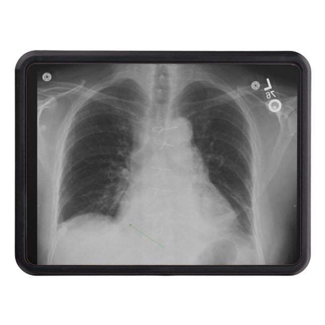 Chest X Ray ~ Hitch cover (Front)