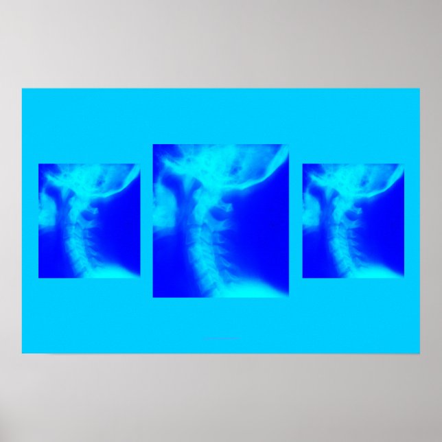 Chiropractic Poster: Lateral Cervical Blues Poster (Front)
