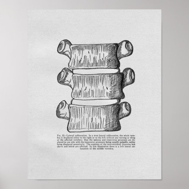 Chiropractic Vertebral Subluxation Vintage Print (Front)