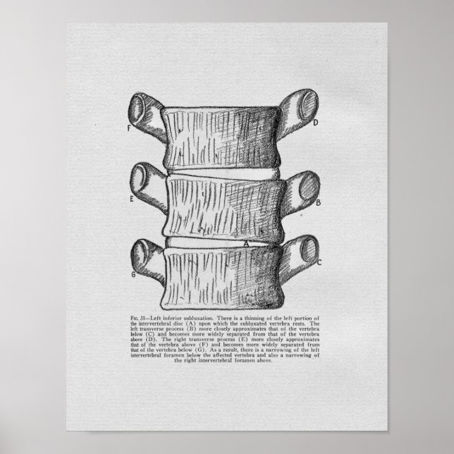 Chiropractic Vertebral Subluxation Vintage Print (Front)