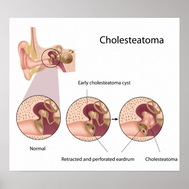 Cholesteatoma middle ear tumour Poster (Front)