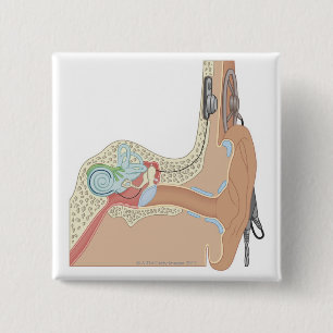 Cochlear Implants 2 Inch Square Button