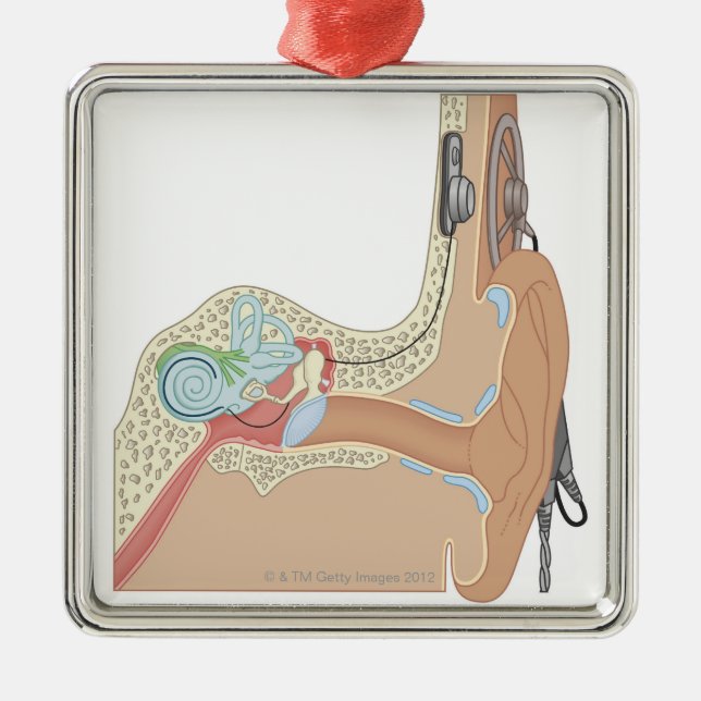 Cochlear Implants Metal Ornament (Front)