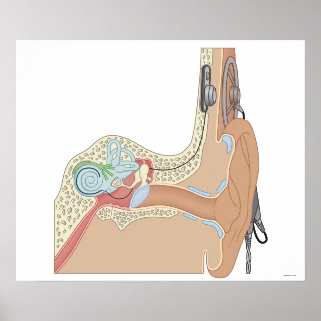 Cochlear Implants Poster (Front)