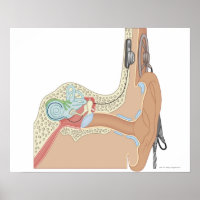 Cochlear Implants