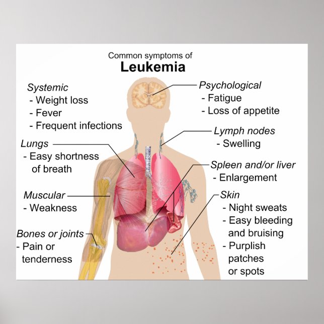 Common Symptoms Chart of Leukaemia Blood Cancer (Front)