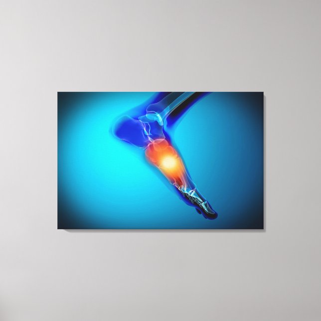 Conceptual Image Of Pain In Human Foot Canvas Print (Front)