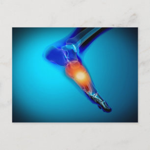 Conceptual Image Of Pain In Human Foot Postcard