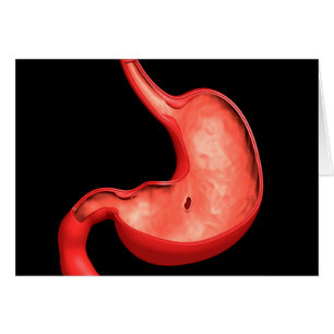 Conceptual Image Of Peptic Ulcer In Stomach