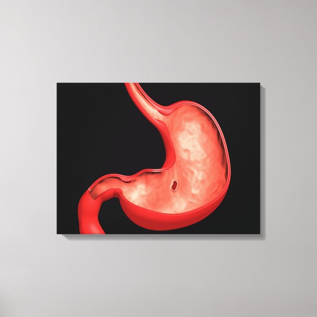 Conceptual Image Of Peptic Ulcer In Stomach Canvas Print (Front)