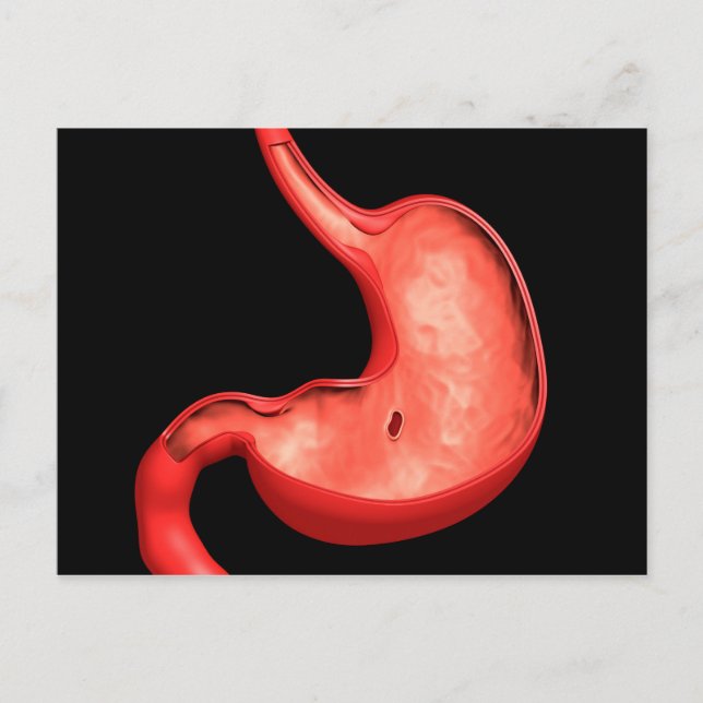 Conceptual Image Of Peptic Ulcer In Stomach Postcard (Front)